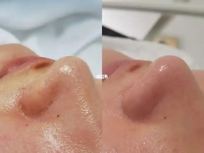 毛孔深层清洁对比图