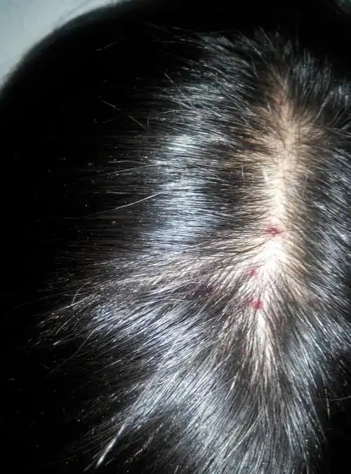 头皮很痒老抓成这样怎么回事怎么办