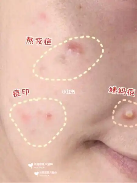 姨妈痘/熬夜痘="临时工"它们不像长期痘痘一样抓着你不放 而是偶尔