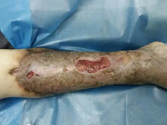 皮肤病坏死十年余