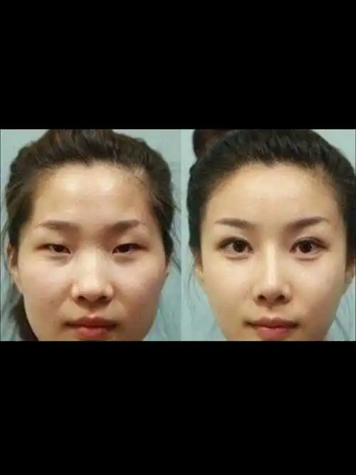 8080双眼皮和单眼皮有什么区别,从美学角度讲,双眼皮_圈子-新氧