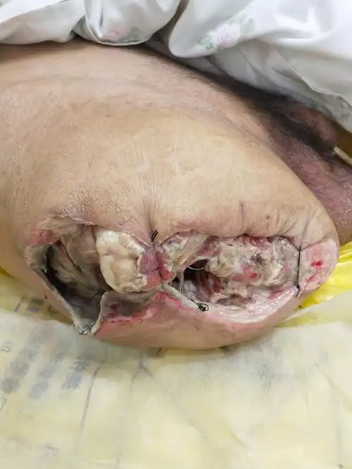 糖足两次截肢送来我院3天不到死亡img_20180203_084913.jpg
