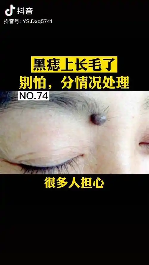 痣上面长了毛会不会影响健康呢痣