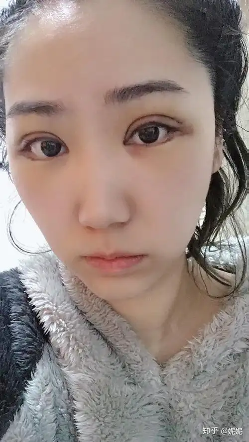 南京全切双眼皮30天恢复记录双眼皮手术需要多少钱