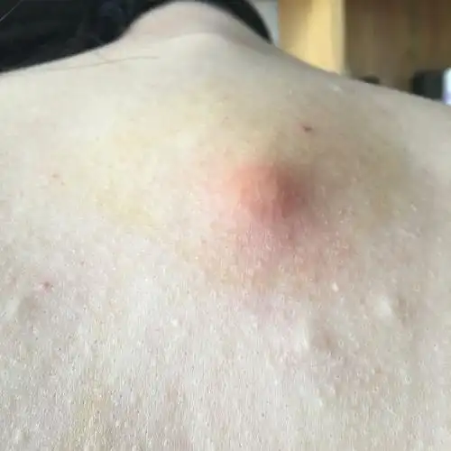 背上长了很大的痘痘… 该怎么弄掉!求帮助啊!