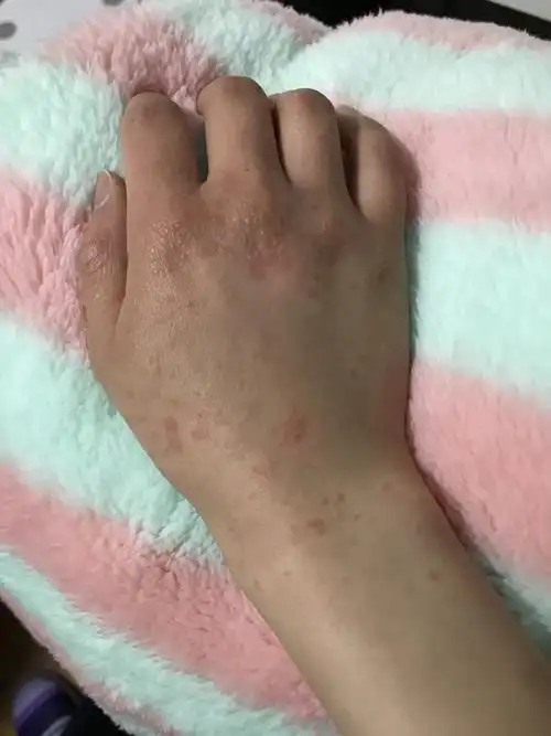 手背上都是一片片红色的疹子 很痒,这是什么,怎么办