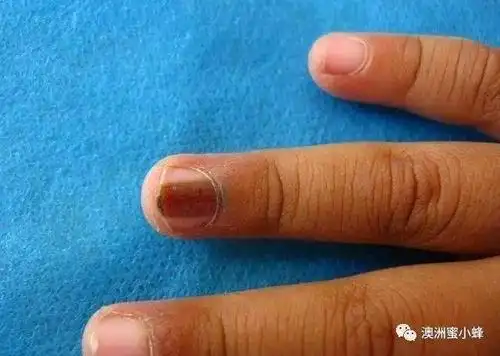 指甲上黑线竟是癌症,已有人中招无法治愈.
