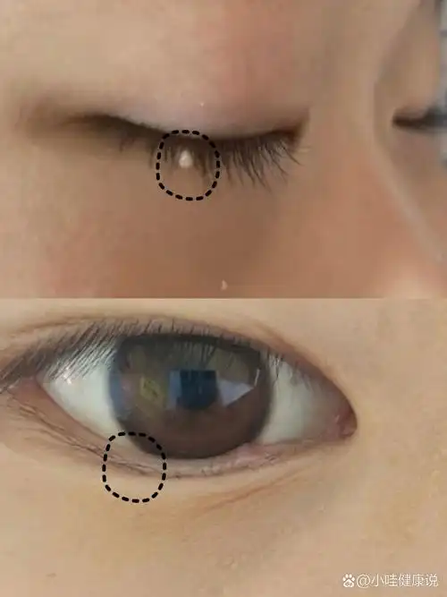 眼睛周围白色的小疙瘩,很多人都不知道这是脂肪粒,是因为生活习惯
