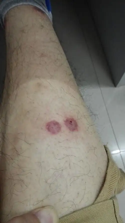 的大疙瘩,还发紫是怎么回事,是蚊虫叮咬还是药物过敏,近期用过皮炎平