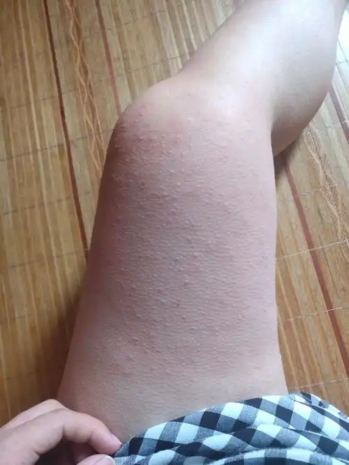 月底要生了,结果来了个全身起红色小疹,有水泡.