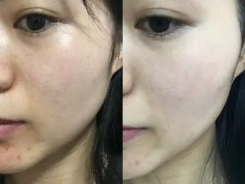 的问题有一定的好转,也不能指望做一次光子嫩肤皮肤就真的变得很好了