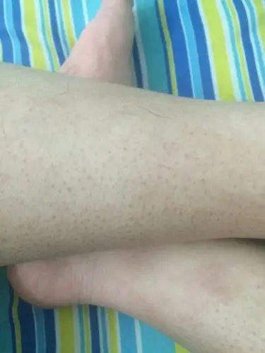 我小腿上这种是废弃物堵住毛孔了