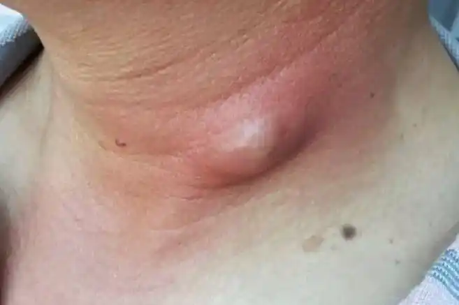 孕妇脖子上长小肉疙瘩图片