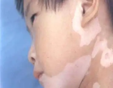 白斑病的治疗方法有哪些