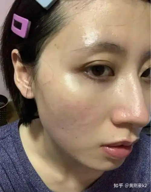 角质层变薄了怎么办要如何修复角质层