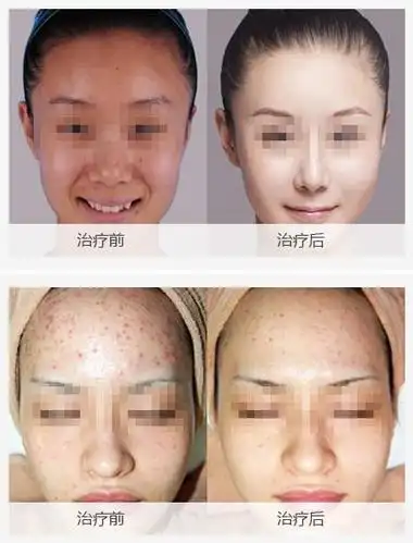 其他换肤试剂等vs果酸活肤3,刺激真皮层胶原再生,紧实肌肤,改善深层