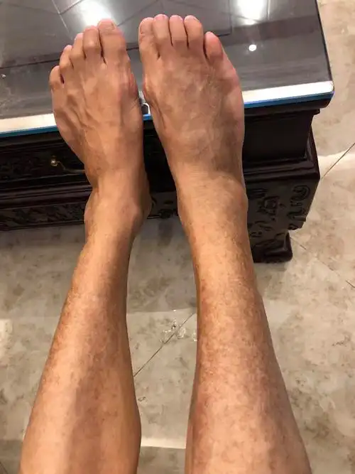 我妈65岁,患糖尿病二型20年,双脚皮肤近2年从脚背开始泛黑至双腿肚