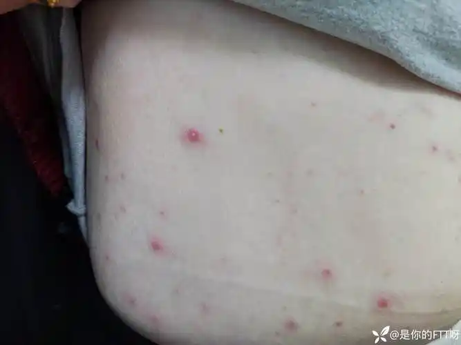 腹部皮疹