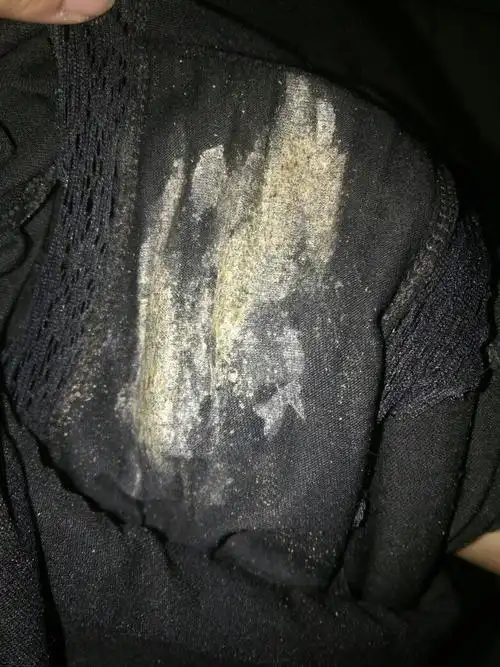 白带为什么这么多