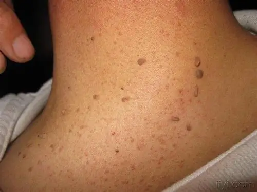 终于知道了我脖子上的小肉瘤是什么情况?