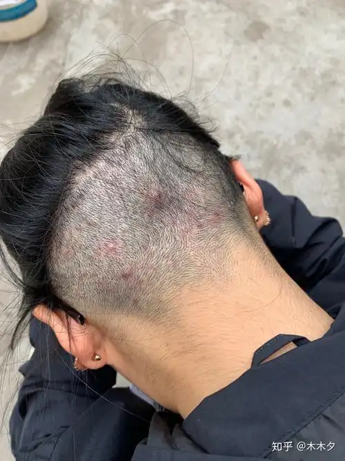 头皮上发毛囊炎该怎么办