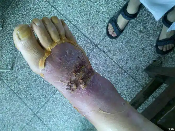 皮肤外科足部溃疡感染3月