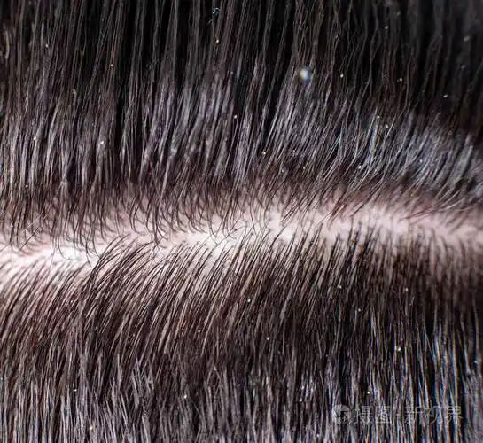 男人黑发上的头皮屑鳞屑去除头皮屑和护发的概念背景宏观
