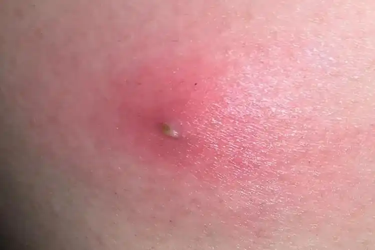 火疖子初起时为毛囊性炎症性丘疹,后期逐渐增大,形成红色硬性结节,有