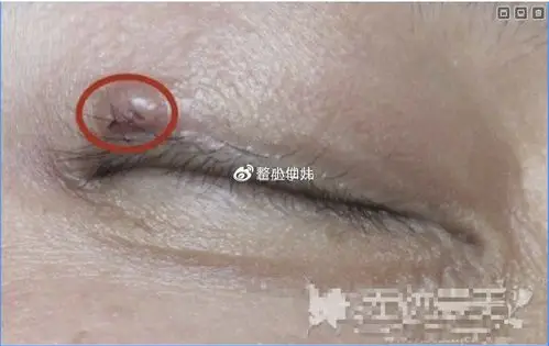 那么埋线双眼皮线结反应怎么处理呢?