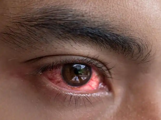 眼睛特别红有好多眼屎是什么原因