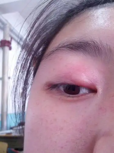 最近总是不等时间段的眼睛浮肿,是为什么?