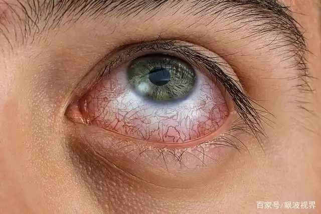 上班族眼睛里出现红血丝,千万不能大意!