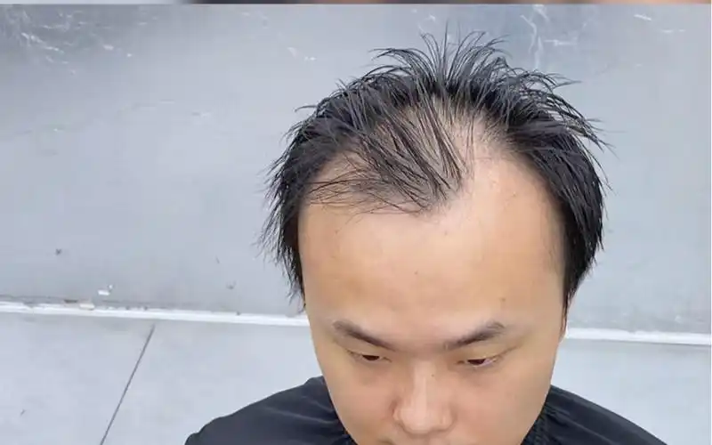 男生m型发际线脱发严重这样做帅到你没朋友