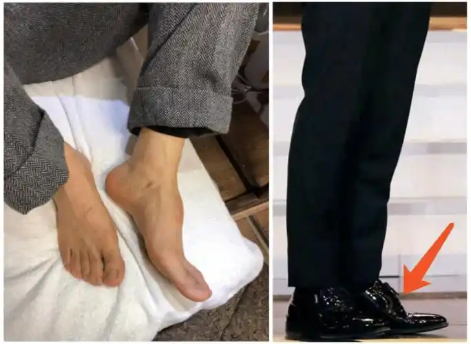 黄晓明首晒脚背受伤图, 回应"增高鞋垫"风波, 粉丝大呼心疼