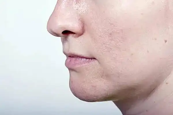 第三个肌肤问题:混合性肌肤