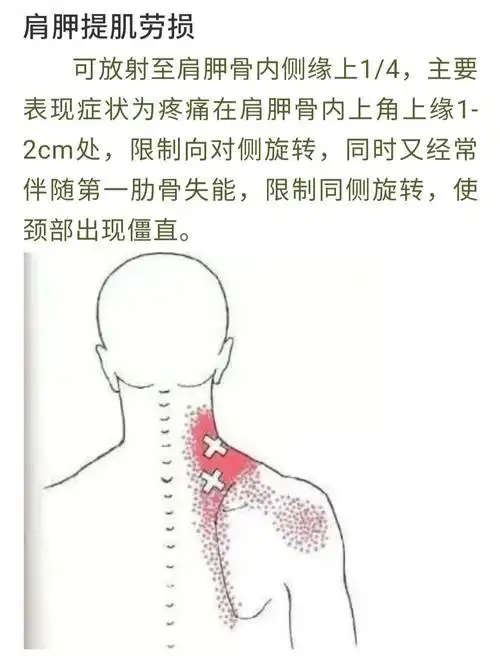 肩胛骨内侧缘疼痛,可能是这十块肌肉劳损了!