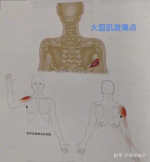 大圆肌激痛点牵涉痛会深入后盂肱关节及三角肌后侧5～10厘米的椭圆