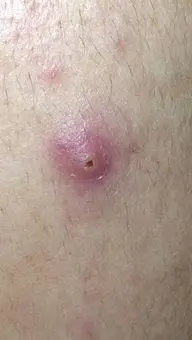 因此根据系统的医治是十分有必要的,我们根据对发炎的控制,能够应用外