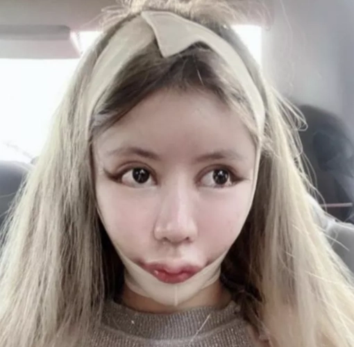 上百次手术,让她的身体出现很多后遗症: 开眼角开太大,睡觉时闭不上眼