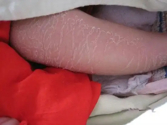 宝宝6个月才被妈妈发现"鱼鳞病",可怜我的儿