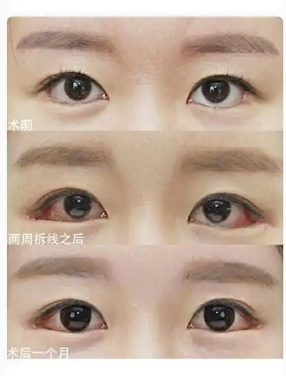 眼睑下至开外眼角图片