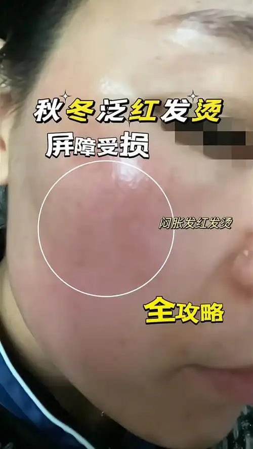 皮肤是不是进入空调房稍微闷热情况下脸上就发红发烫给大家总结了原因