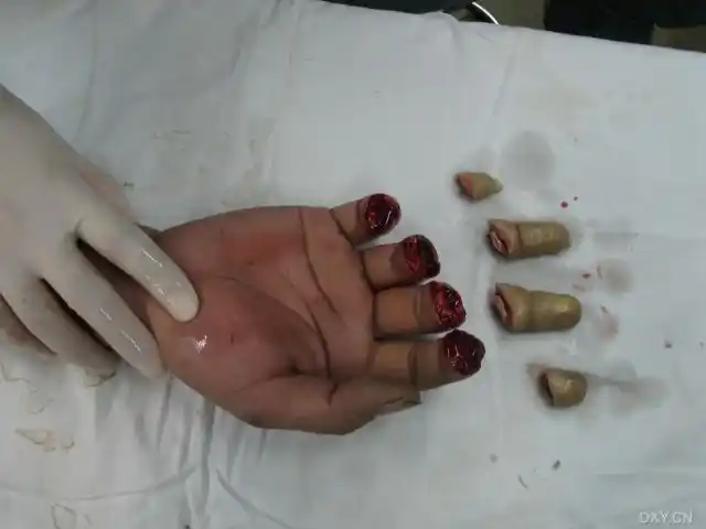 一例四指离断伤 - 骨科专业讨论版 -丁香园论坛
