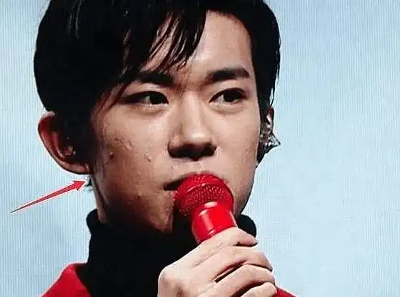 易烊千玺节目生图流出,满脸痤疮坑坑洼洼,粉丝:脱粉一分钟