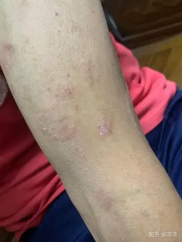 这种藓有什么偏方断根