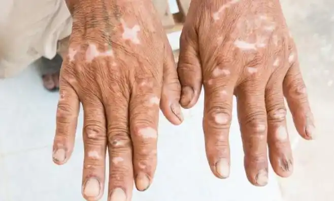 白癜风是一种常见的慢性色素脱失性皮肤病,其特征是皮肤上出现白色