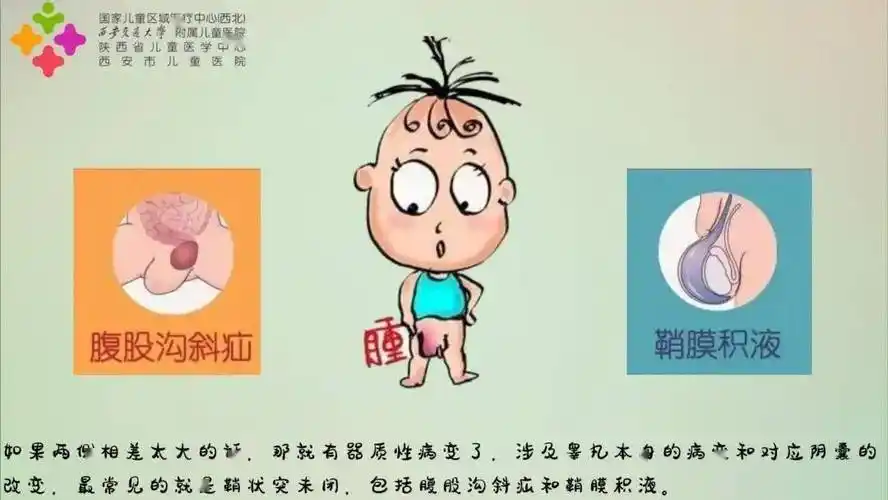 宝宝"蛋蛋"大小不一样是什么原因?医生手绘告诉您~_手术_治疗_腹股沟