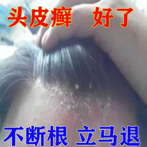 头皮藓药真菌感染头皮癣专用药膏头部牛皮癣银屑癣外用去头藓药膏