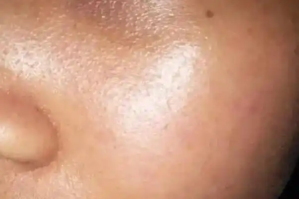 皮肤出油多是什么原因皮肤出油严重毛孔粗大如何改善