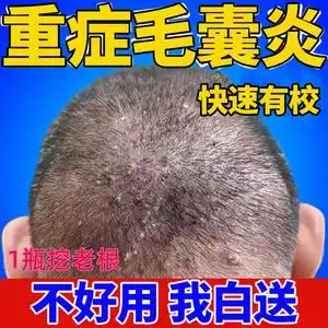 治疗头皮毛囊炎专用前胸后背私处头部脖子马拉色菌痘痘中药酊膏药